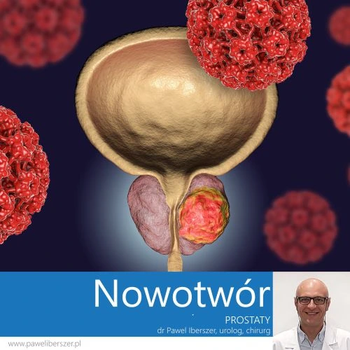 Leczenie nowotworu prostaty, Lublin, cząsteczka chorobowa, dr Paweł Iberszer